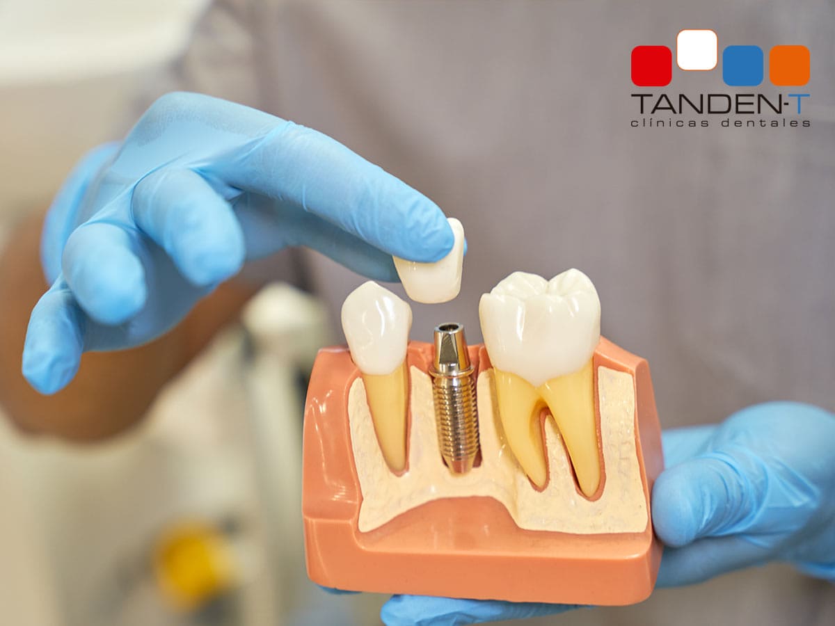 Implantes dentales en el Casar