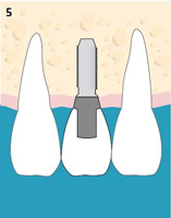 Færdigt implantat