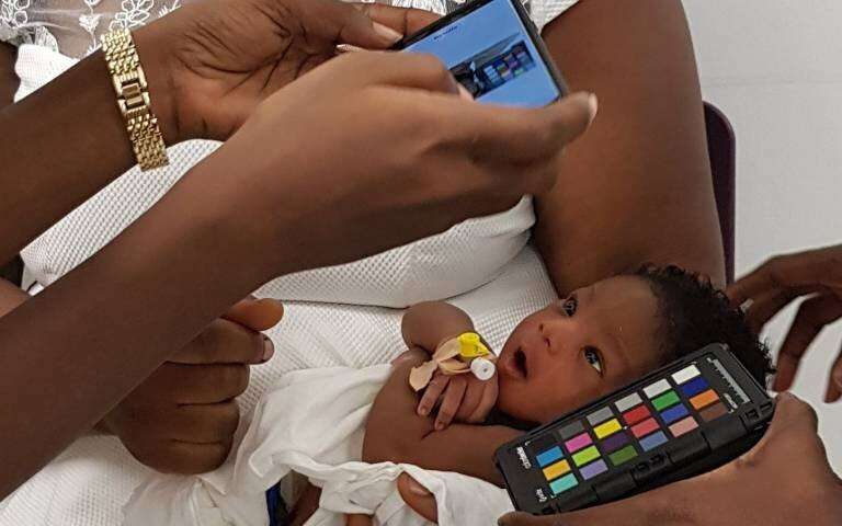 Credit: Dr Christabel Enweronu-Laryea, University of Ghana. Detecting anemia earlier in children using a smartphone