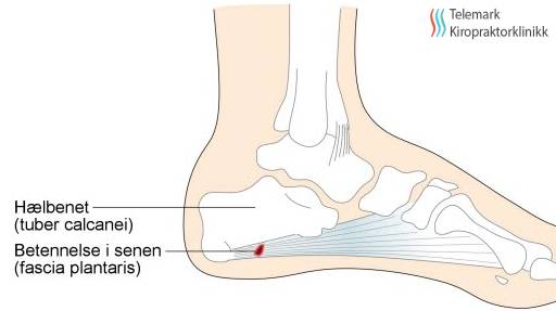 Smerte under foten? Da kan det være plantar fascitt - Telemark  Kiropraktorklinikk | Kiropraktor i Porsgrunn og Bø