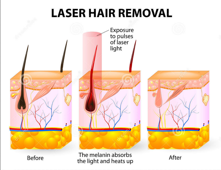 Laser Hair Removal Warwickshire West Midlands