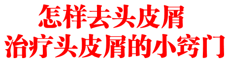 怎样去头皮屑 治疗头皮屑的小窍门