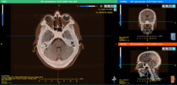 SmartFuse-HN-AAPM