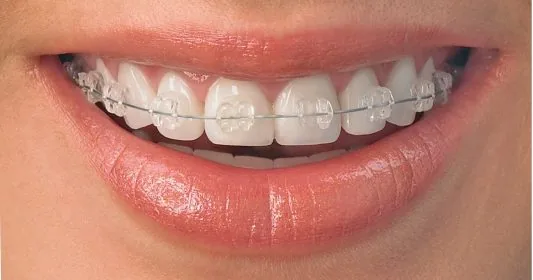 Appareil orthodontique avec attaches en céramique