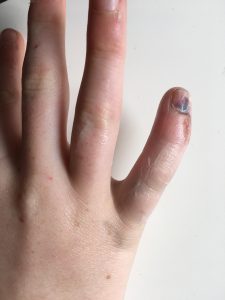 Thursday Plantation – EHBO crème en zalf met tea tree