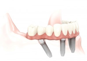 Dental Implants Glasgow