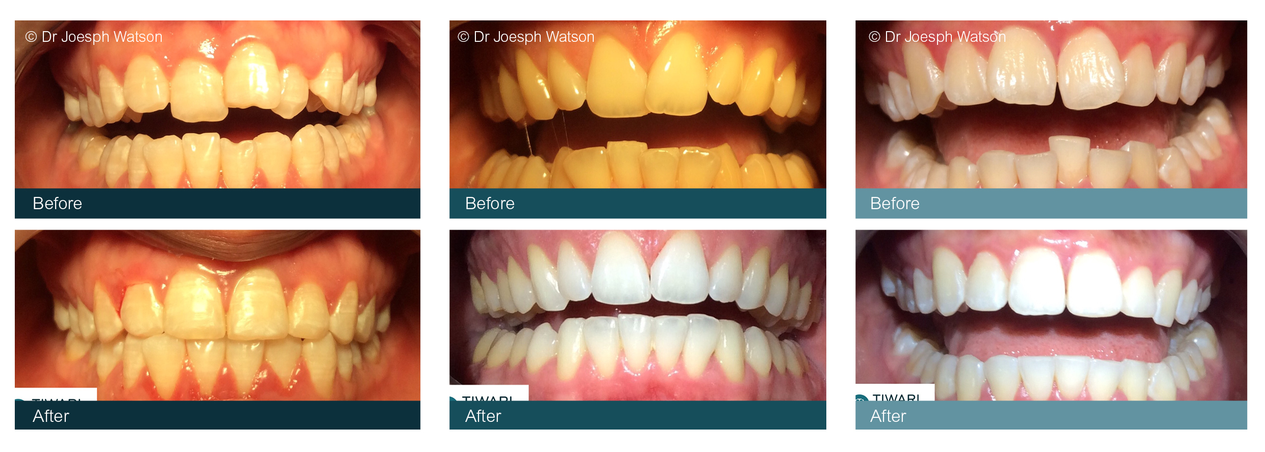 Teeth Straightening Glasgow