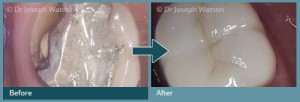 Before and after All Ceramic Crowns Treatment IMages