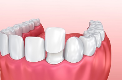 Do dental veneers treat sensitivity?