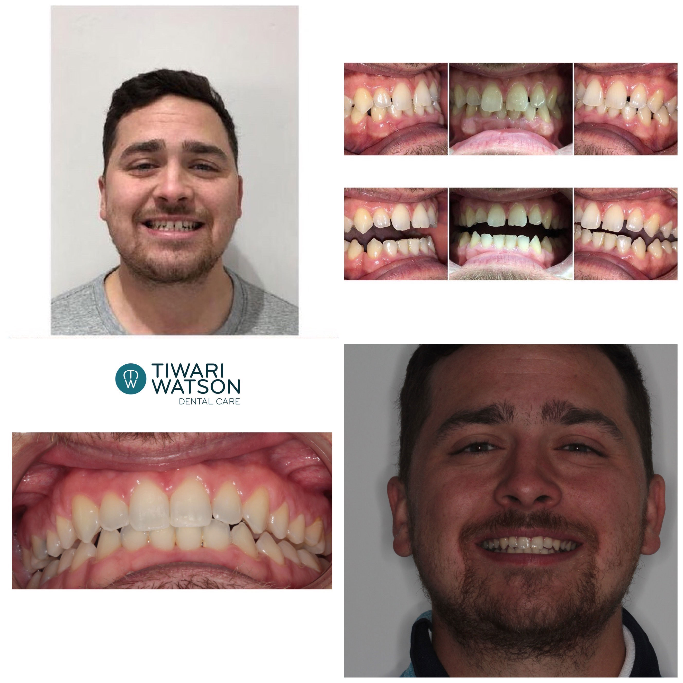 Invisalign Glasgow