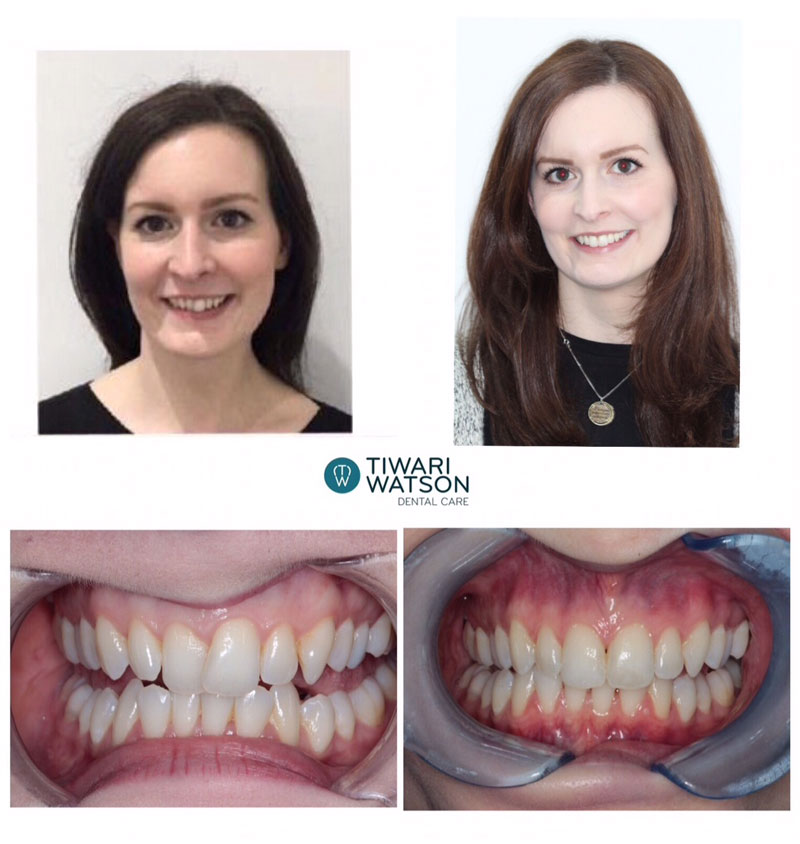 Invisalign Glasgow