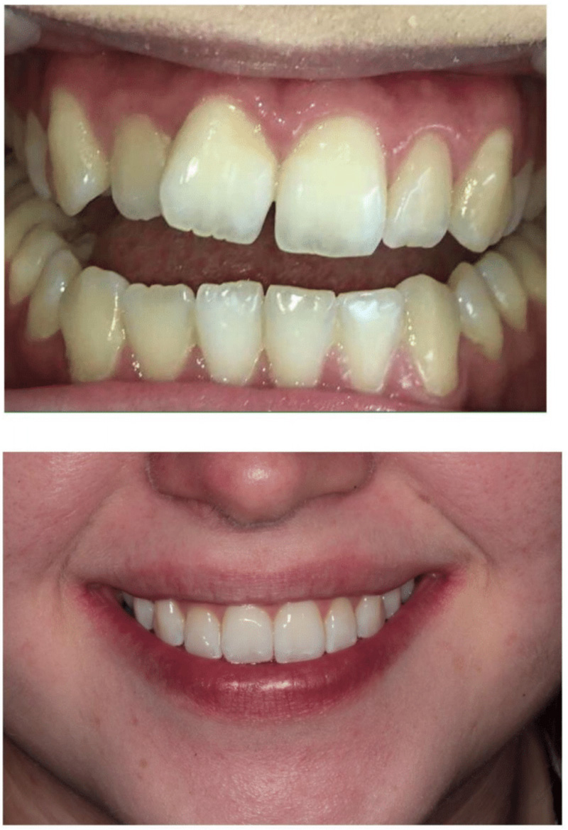 Invisalign Glasgow