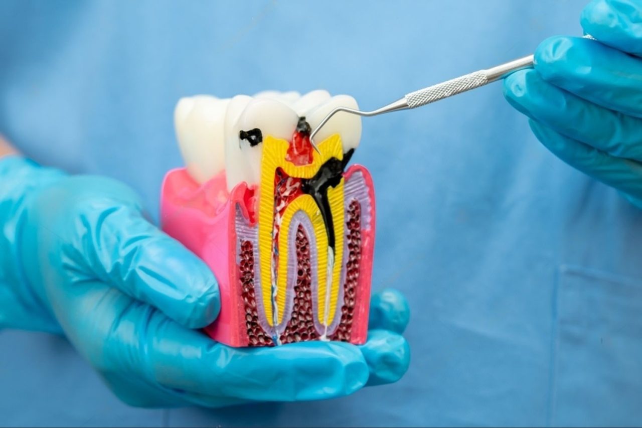 10-Root Canal Treatment