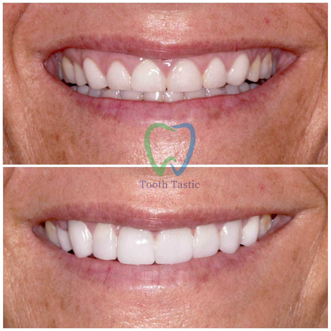 smiling-dental-porcelain-veneers-before-after-11