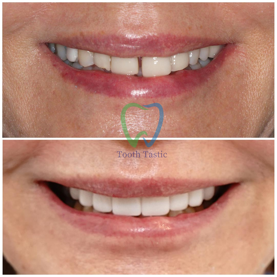 smiling-dental-porcelain-veneers-before-after-1