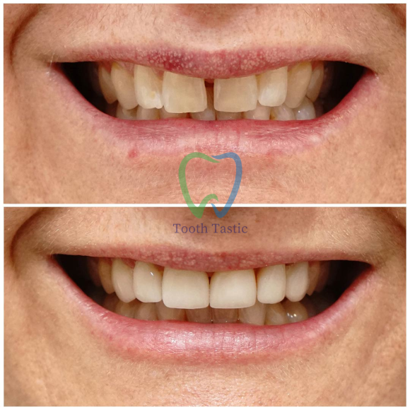 smiling-dental-porcelain-veneers-before-after-3