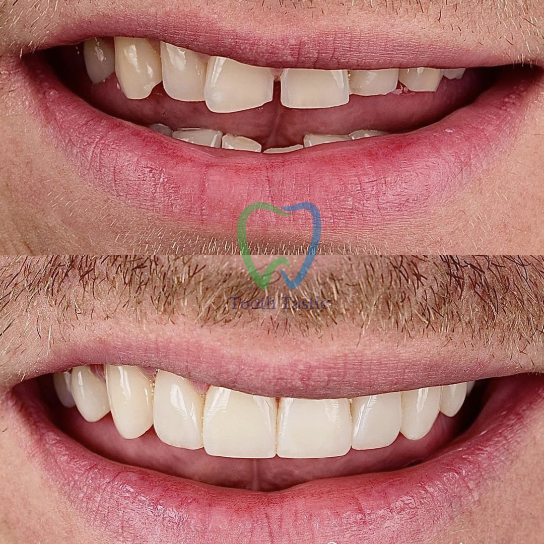 smiling-dental-tooth-bonding-before-after-3