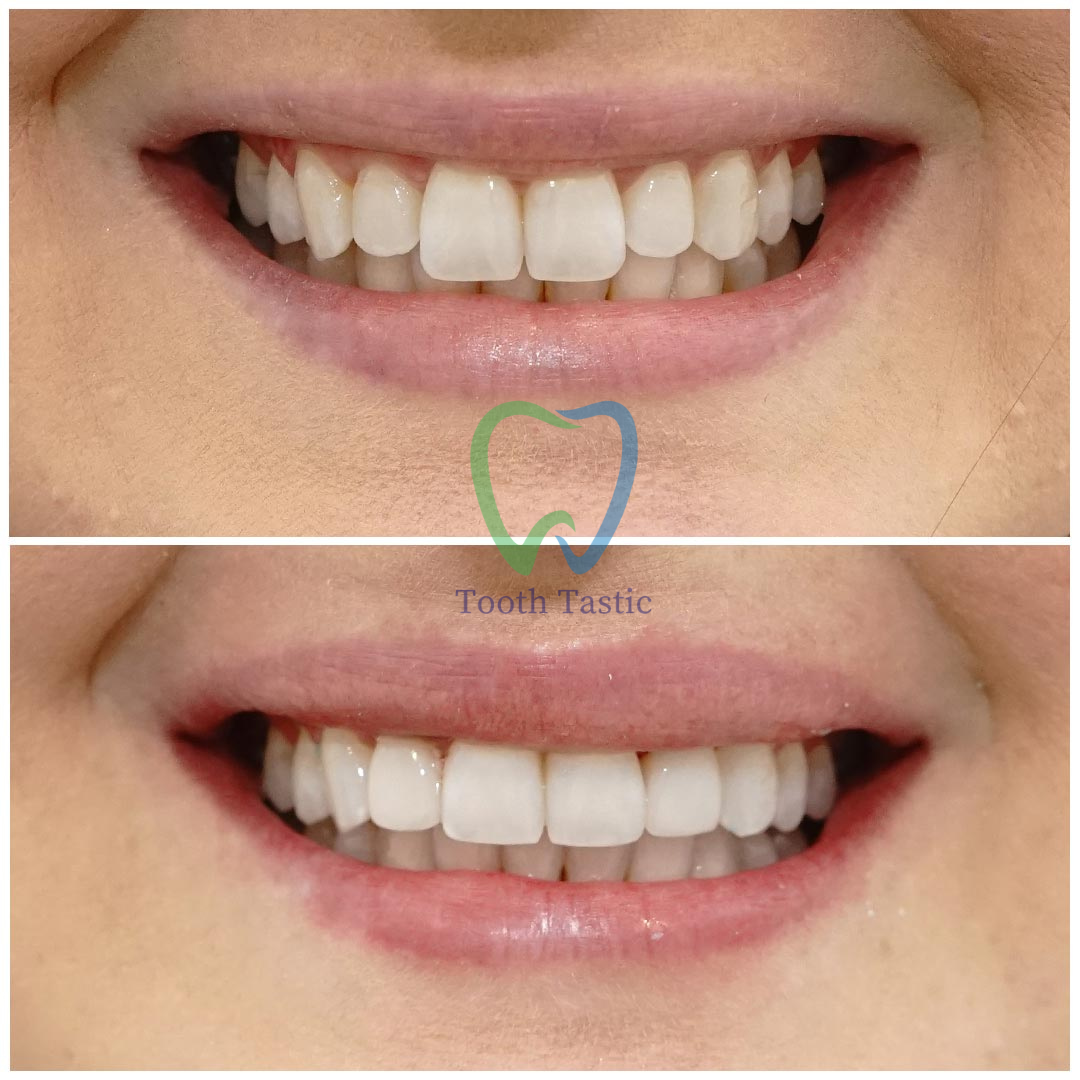 smiling-dental-tooth-bonding-before-after-5