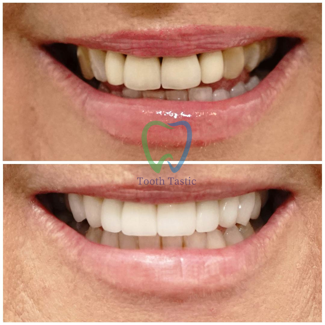 smiling-dental-porcelain-veneers-before-after-8