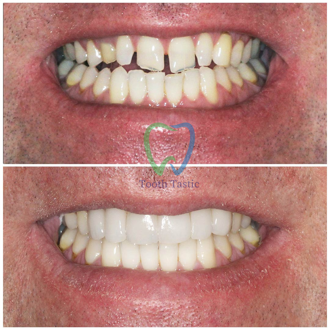 smiling-dental-porcelain-veneers-before-after-9