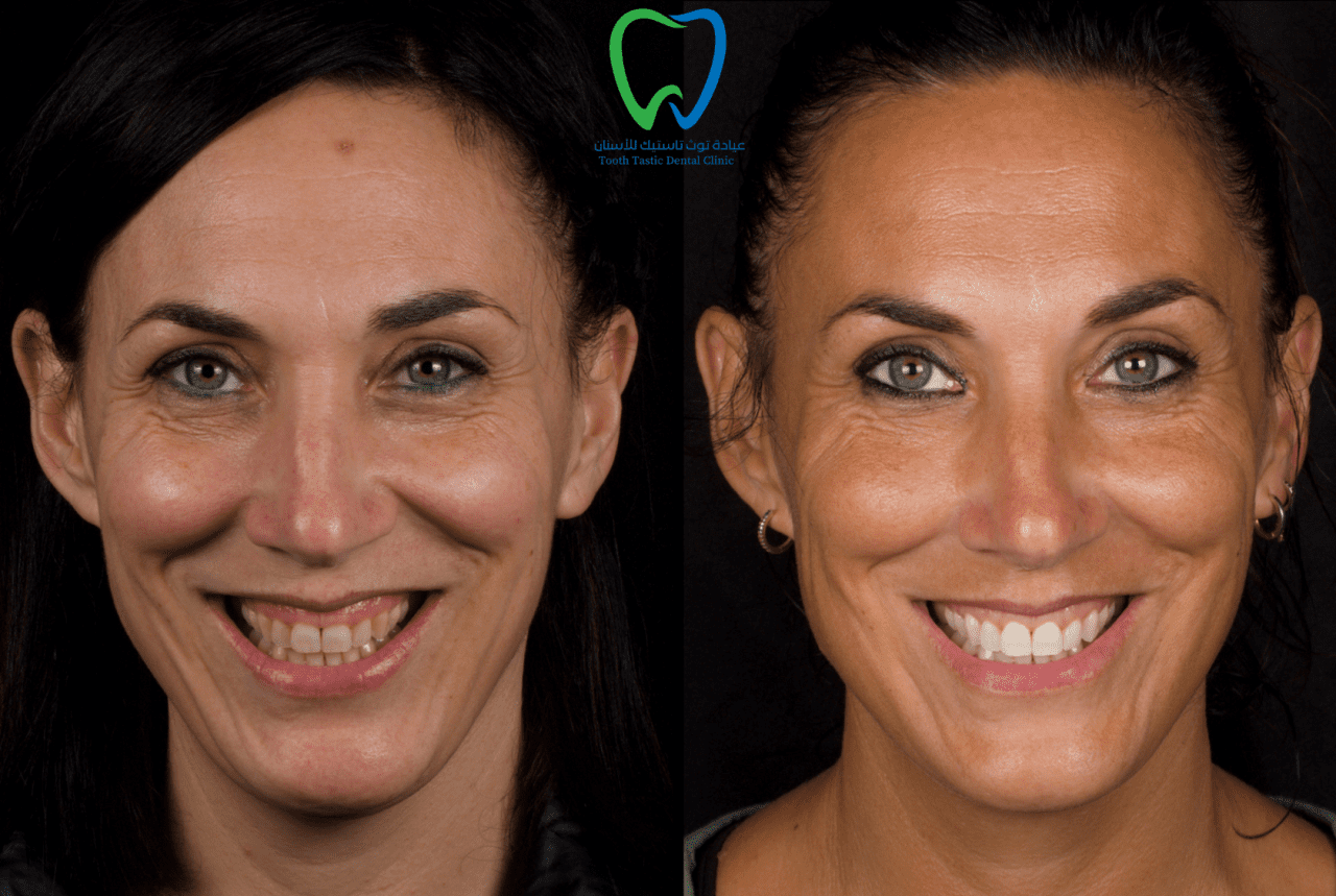 teeth-whitening case