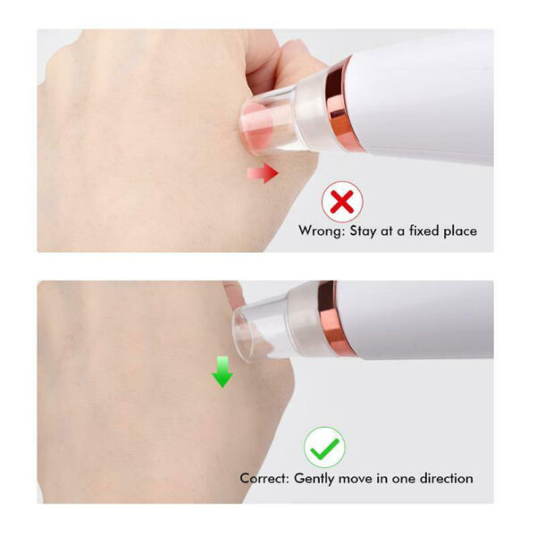6 Nozzle Electric Acne Pimple Blackhead Remover for Face and Nose Vacuum- USB Charging_5