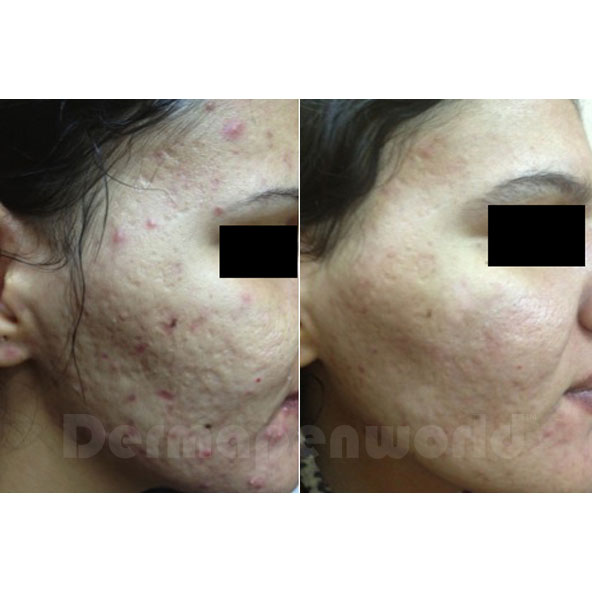 Dermapen Microneedling Before and After
