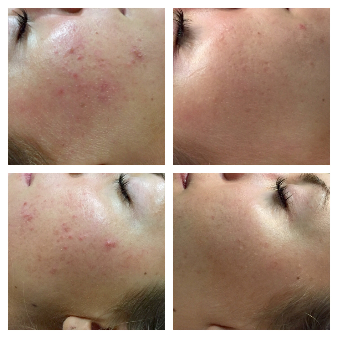 Dermapen Microneedling Before and After