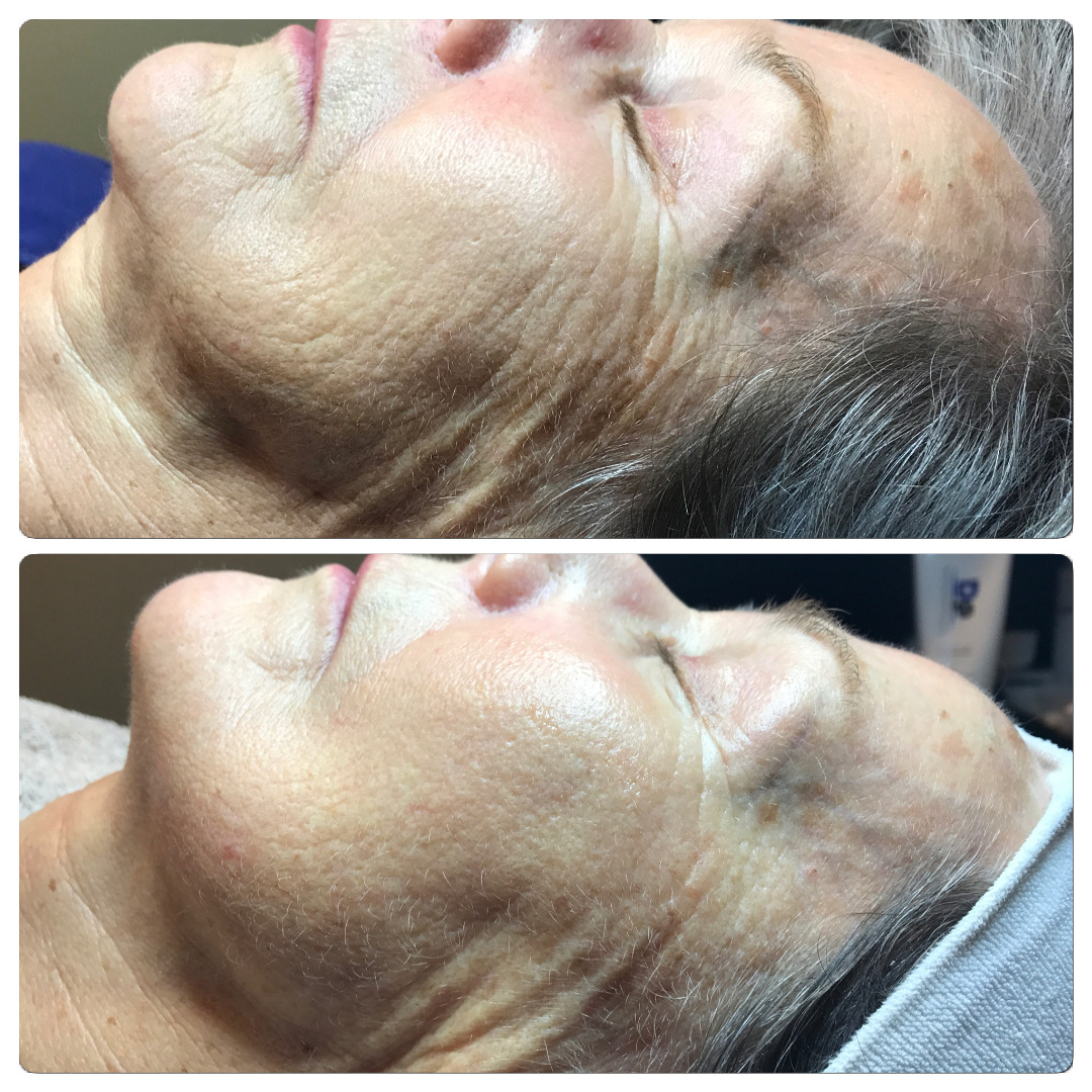 Dermapen Microneedling Before and After