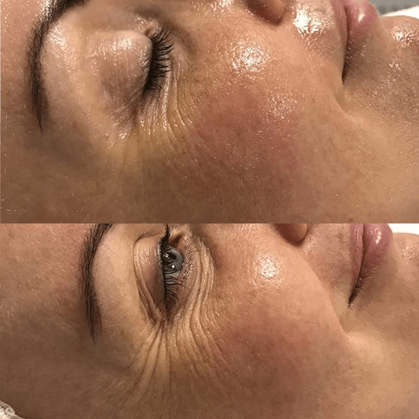 DermaOxy Before & After images