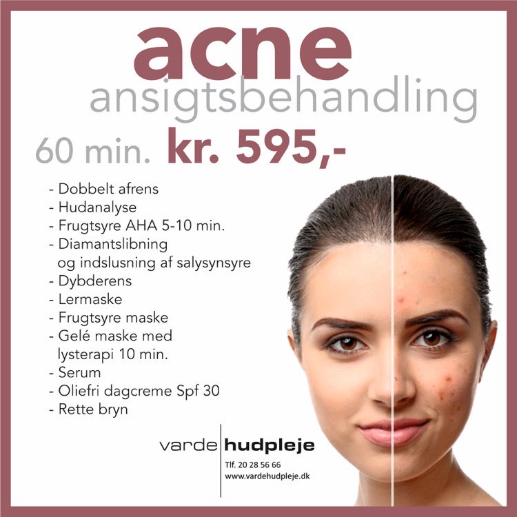 Acne Ansigtsbehandling 595,-