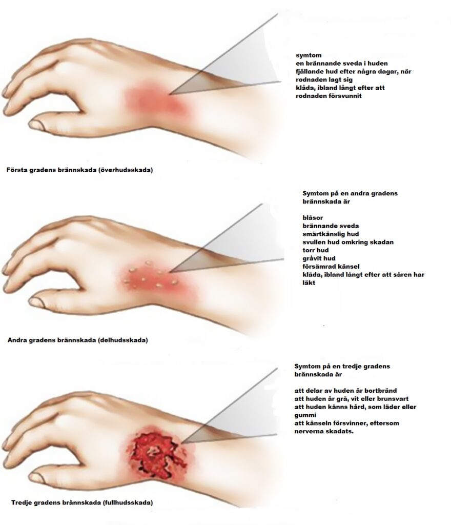 Denna bild har ett alt-attribut som är tomt. Dess filnamn är 3.grader.brannskada-2-880x1024.jpg
