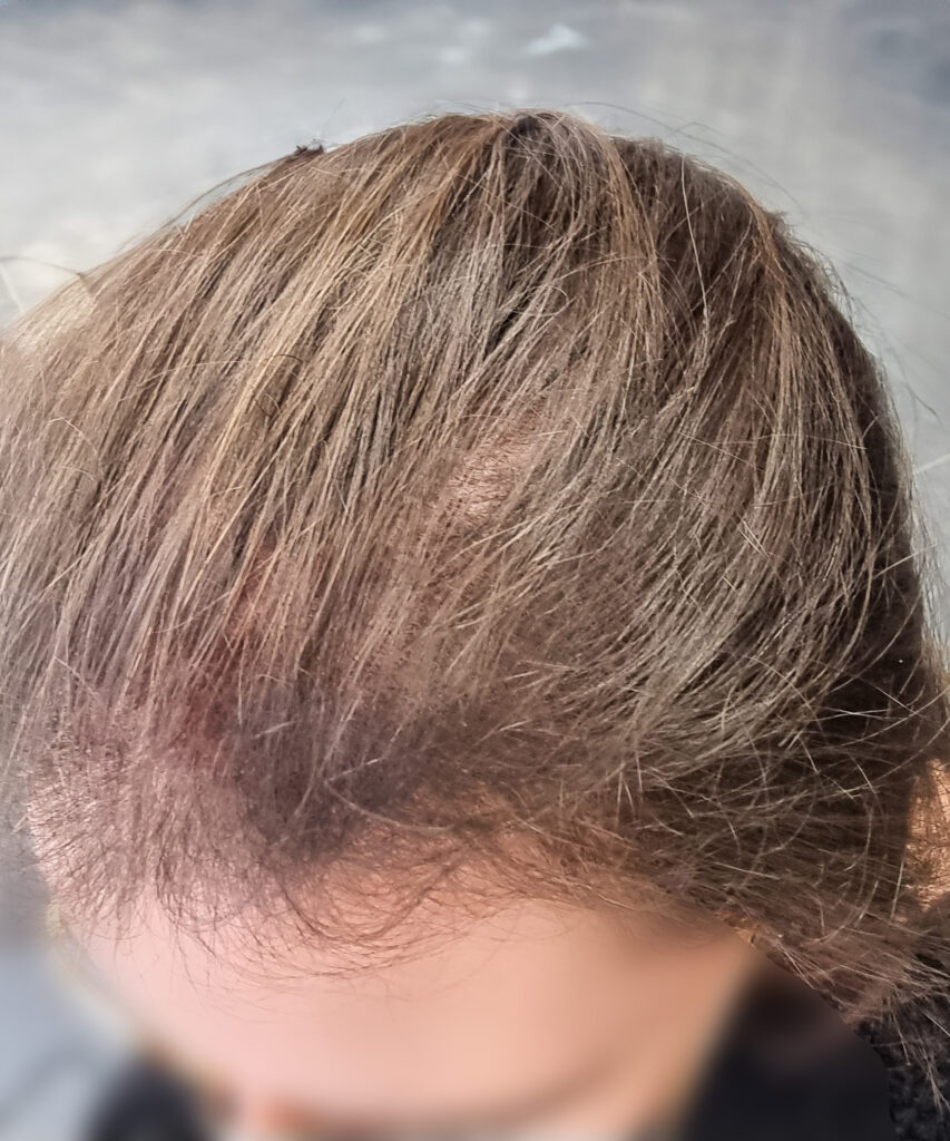 Successful hair restoration by Veva Brands for a woman overcoming hair issues