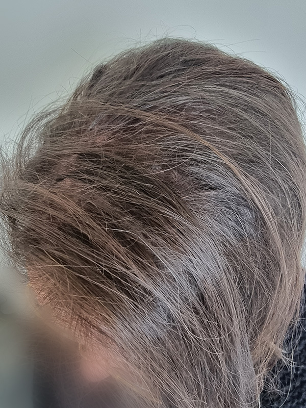 Successful hair restoration by Veva Brands for a woman overcoming hair issues