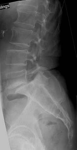 Спондилолистез - причина, симптомы, клинические признаки и лечение