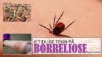 6 tidlige tegn på borreliose ferdig