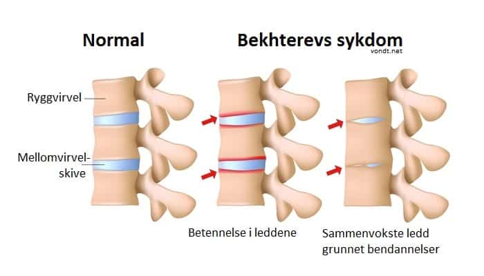 A gerinc osteoarthrosisa