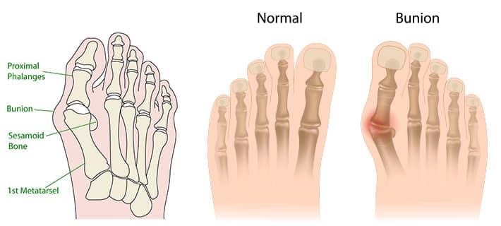 Bunion - Hallux Valgus