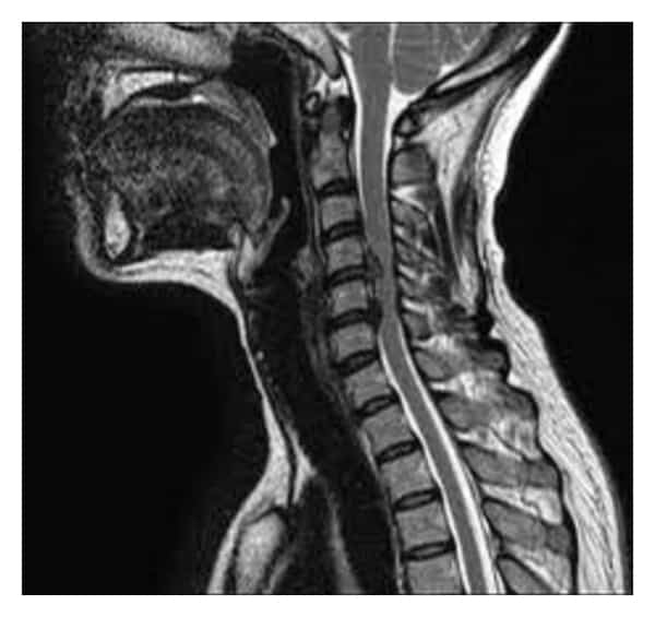 Blanco Herstellen Herstellen Cervicale myelopathie - Symptomen, oorzaak, remedies en behandeling.