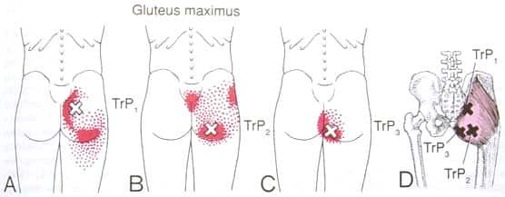 gluteus medius trigger point