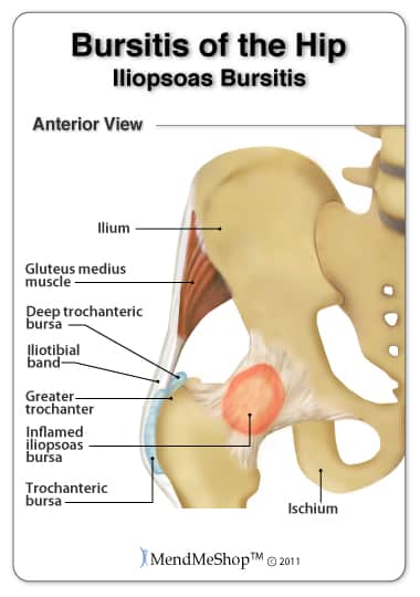 Iliopsoas bursitis van lies, slijmvliezen)