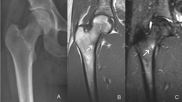 amely segít a csípőízület fájdalmában mellkasi osteochondrosis kezelése