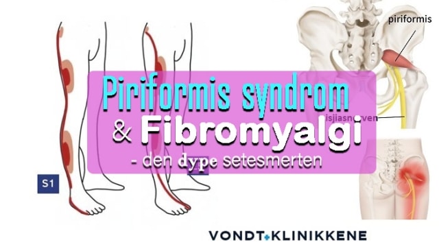 Piriformis Syndrom Og Fibromyalgi Den Dype Setesmerten