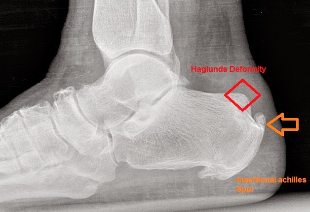 Haglunds deformitet / hæl (benkul på hælen) | Råd og informasjon.