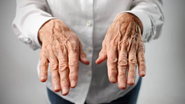 10 Tidlige Tegn på Parkinsons Sykdom | Vondt.net