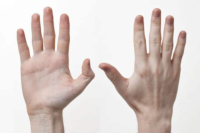 Fingerledbetændelse | Symptomer, diagnose, årsag og behandling