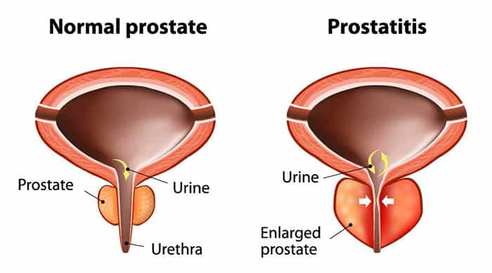 Betændelse i prostata | Årsag, diagnose og symptomer