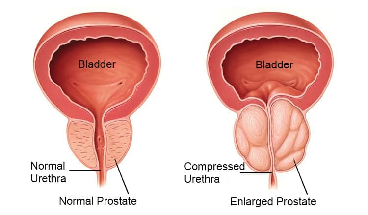mărirea glandei prostatei)