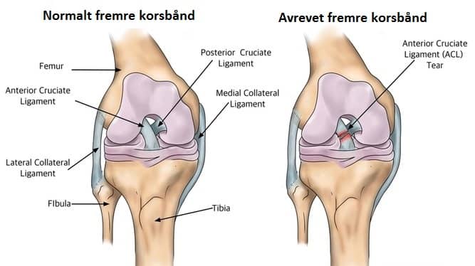 Fremre korsbånd (ACL) ruptur / avrivning / skade | Symptomer, behandling