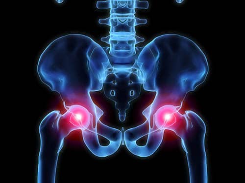 tratamentul osteoartritei deformante a articulației șoldului